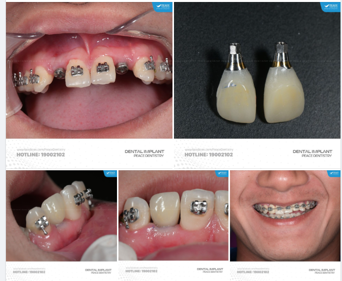 CA LÂM SÀNG ĐIỀU TRỊ  LIÊN CHUYÊN KHOA CHỈNH NHA, IMPLANT