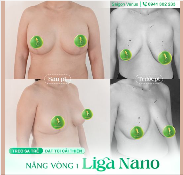 LOẠI BỎ MỌI KHUYẾT ĐIỂM V1 VỚI LIGA NANO KẾT HỢP TREO SA TRỄ