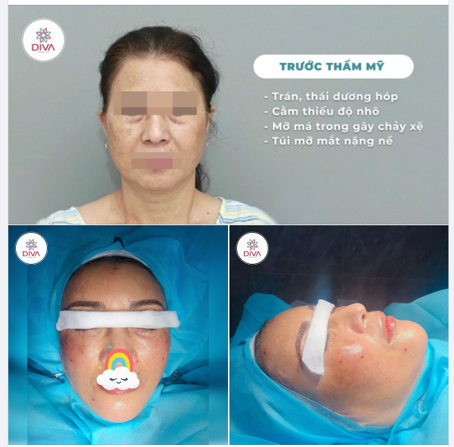 TRẺ HÓA TOÀN DIỆN, ĐIỀU TRỊ CHẢY XỆ HIỆU QUẢ SAU THẨM MỸ
