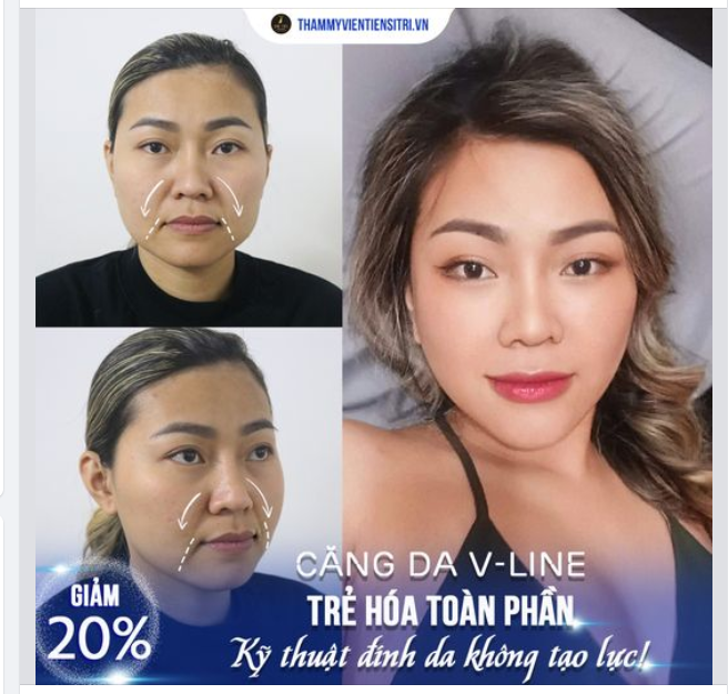 Trầm trồ trước nhan sắc trẻ hóa nhờ bàn tay vàng của Dr.Trí CĂNG DA GIẤU SẸO