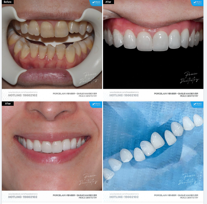 SMILE MAKEOVER - PORCELAIN VENEER: