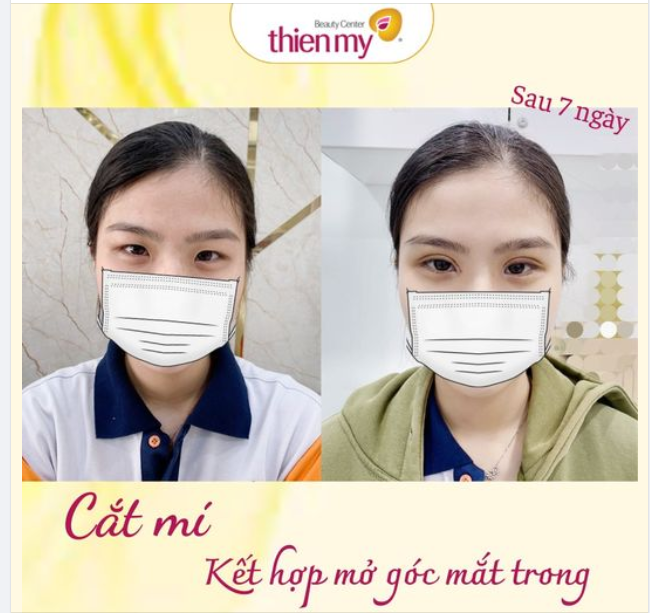 Ưu điểm khi mở góc mắt trong: