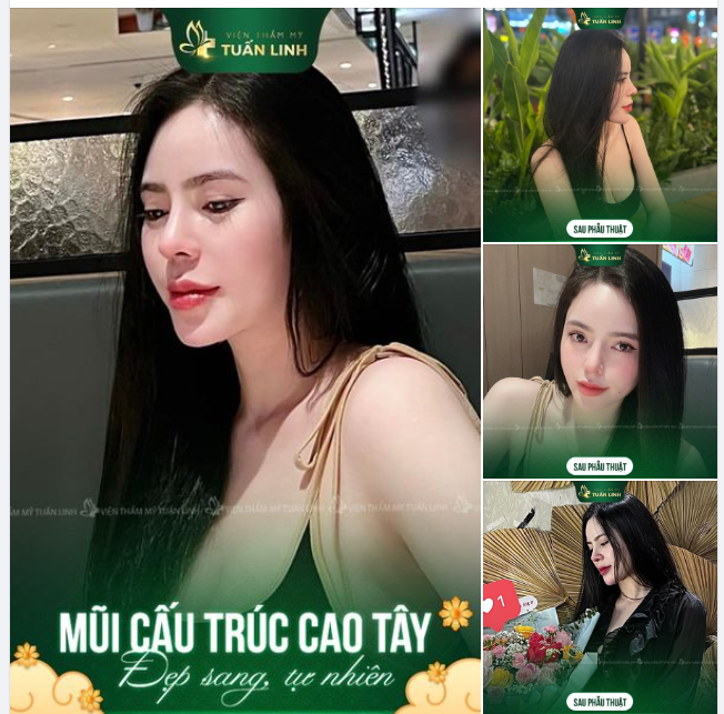 Mũi cấu trúc đẹp sang tự nhiên - Bền mãi cùng thời gian!!