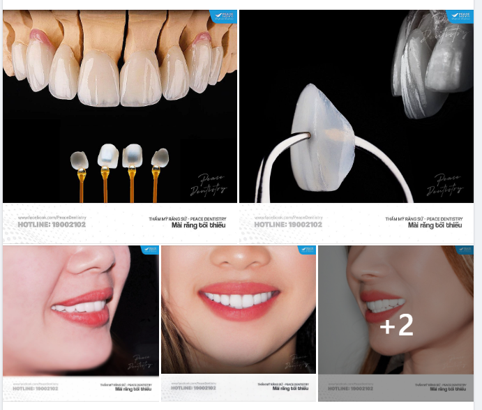 MỘT CA  THẨM MỸ RĂNG SỨ THÀNH CÔNG: 4 YẾU TỐ PHẢI CÓ!