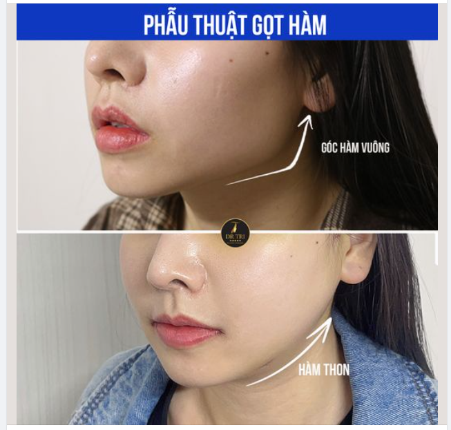 MÀN LỘT XÁC NGOẠN MỤC SAU KHI GỌT HÀM