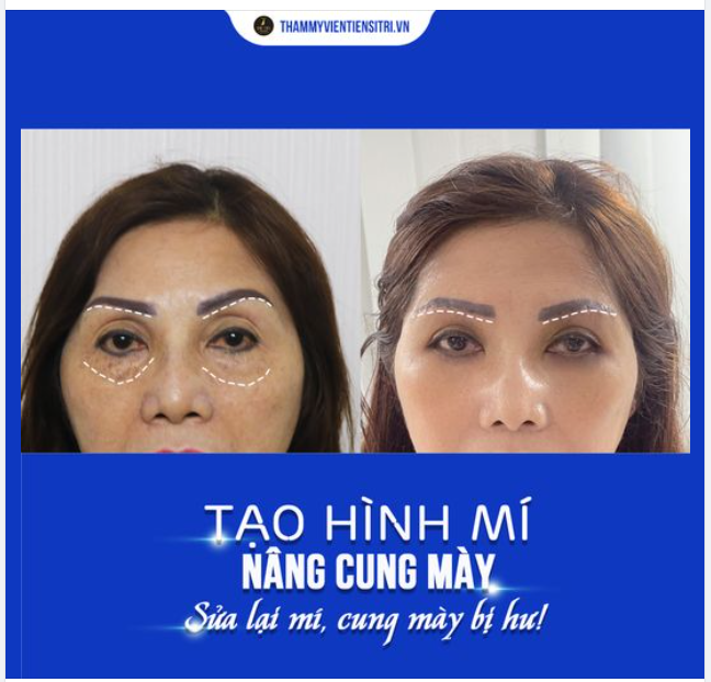 Bí quyết để sở hữu đôi mắt đẹp đó là đến gặp Tiến sĩ Bác Sĩ Đỗ Thành Trí!!