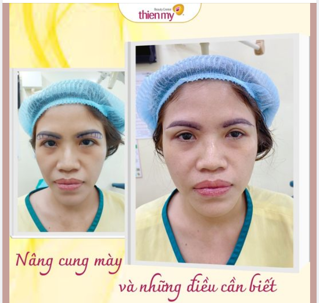 Những đối tượng sau được chỉ định sẽ thích hợp nhất để nâng cung mày:
