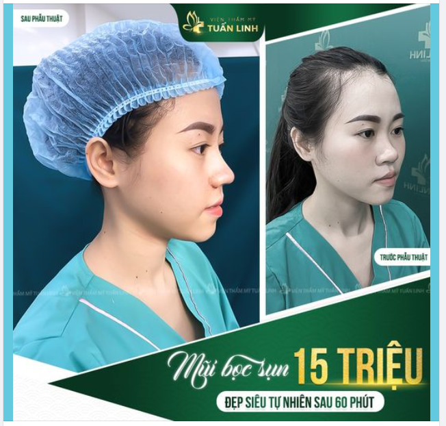 ĐỪNG BỎ QUA KHUYẾN MÃI NÀY NẾU BẠN ĐANG CÓ Ý ĐỊNH NÂNG MŨI!!