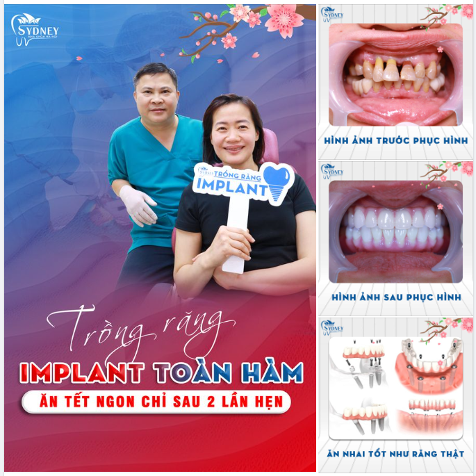 TRẺ HÓA HƠN, ĂN NHAI TỐT HƠN SAU TRỒNG IMPLANT