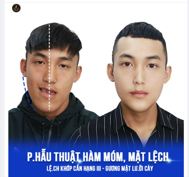 Kết Quả Sau 07 Ngày Chỉnh Lệch Khớp Cắn Hạng III - Gư.ơng Mặt Lưỡi Cày