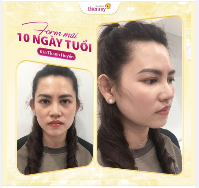 DÁNG MŨI 10 NGÀY TUỔI CỦA KH THIỆN MỸ NHƯ THẾ NÀO?