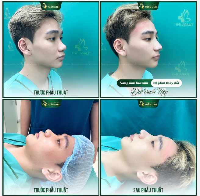 NÂNG MŨI BỌC SỤN CHO CHÀNG TRAI 2K6 - Form mũi Lline tự nhiên, cá tính dành cho nam giới