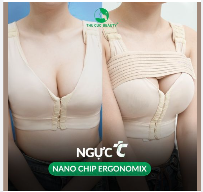 Nâng ngực Nanochip Ergonomix