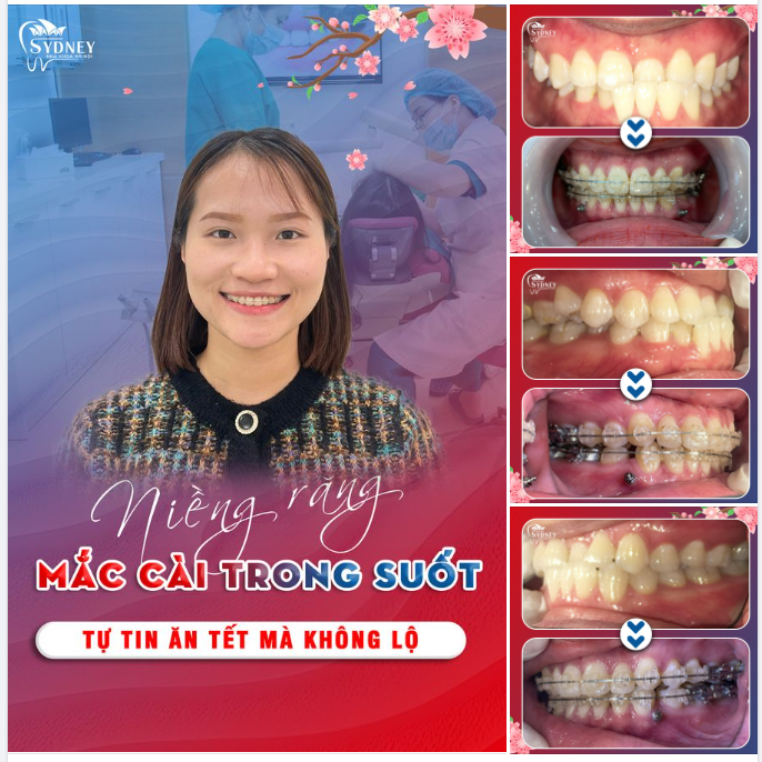 NIỀNG RĂNG MẮC CÀI PHA LÊ - ĐÓN NỤ CƯỜI XINH TƯƠI