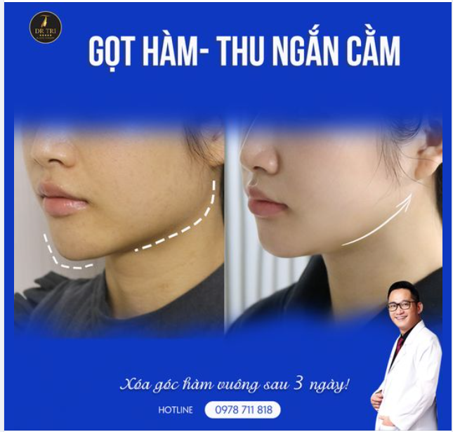 Xóa bỏ góc hàm vuông, thu ngắn cằm tại Dr Trí chỉ sau 3 ngày