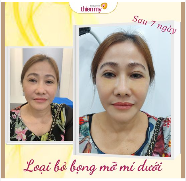 Lấy mỡ bọng mắt là phương pháp thẩm mỹ giúp loại bỏ phần da, mỡ thừa, nếp nhăn vùng mắt dưới và khâu phần da dưới mắt để thon gọn nhằm giải quyết tình trạng chảy xệ và bọng mỡ của vùng mắt.