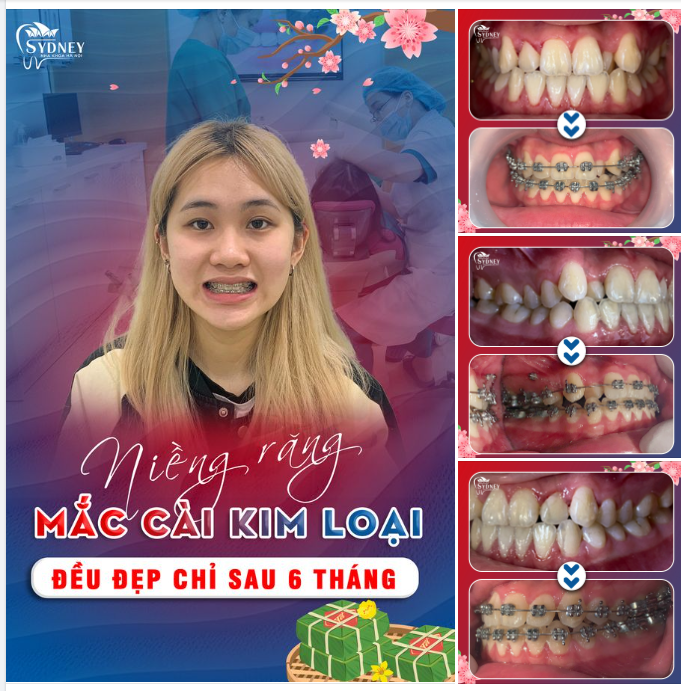 TỰ TIN CƯỜI SAU 6 THÁNG NIỀNG RĂNG MẮC CÀI KIM LOẠI
