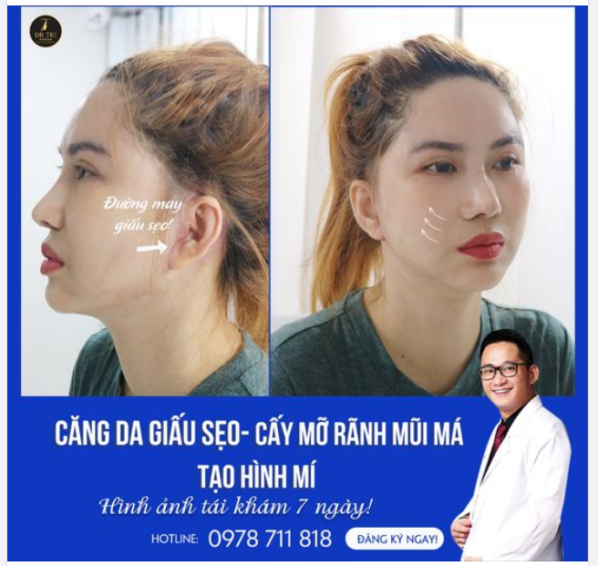 Xem ngay kết quả Căng da giấu sẹo Cấy mỡ rảnh mũi má Tạo hình mí sau 7 ngày đẹp mê li