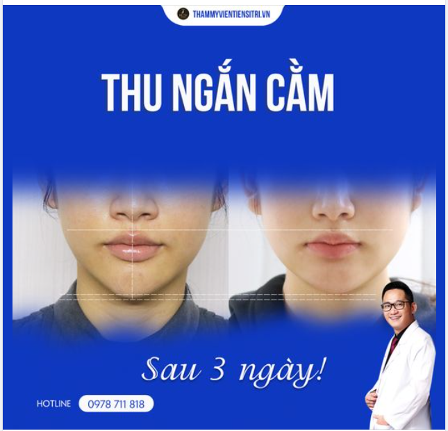Tiến Sĩ Bác Sĩ Đỗ Thành Trí thực hiện ca Thu Ngắn Cằm