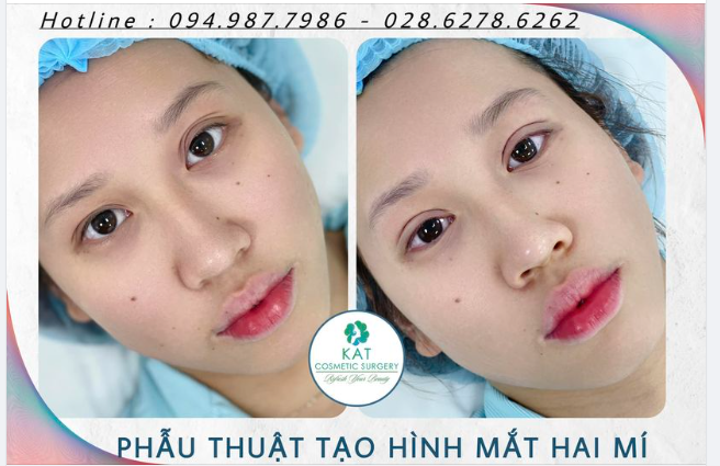 “ Tạm biệt đôi mắt không đều, sụp mí, nhiều nếp mí​​​​​​​ “