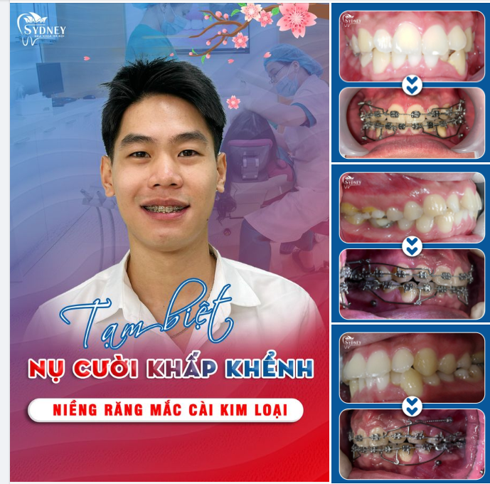BẤT NGỜ SAU 6 THÁNG NIỀNG RĂNG MẮC CÀI