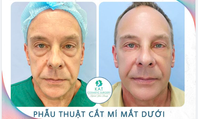 Cắt mí dưới cho vị khách đến từ Mỹ - Xóa tan dấu vết thời gian 