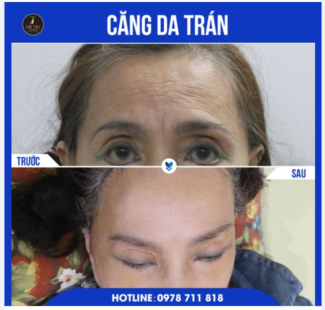 U70 Lấy lại tuổi xuân sau khi Căng Da Trán
