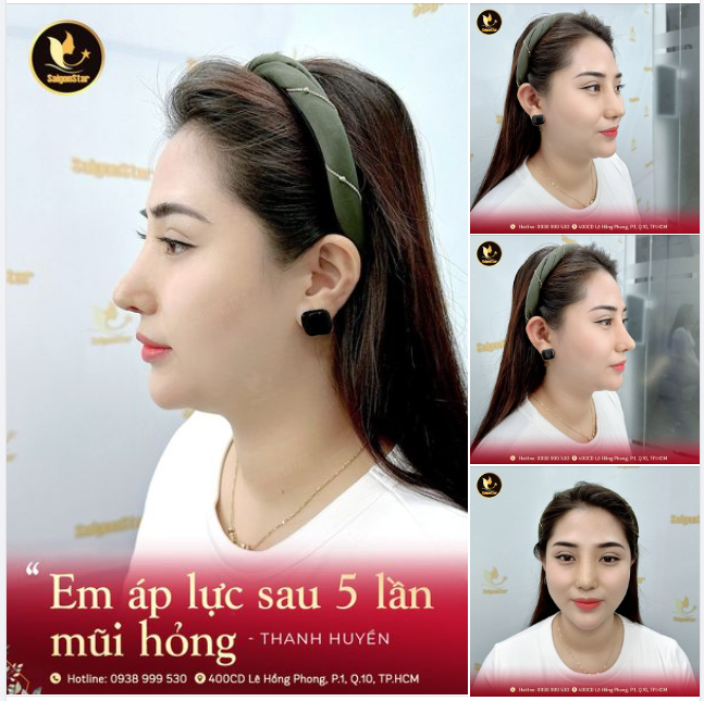 “Em áp lực sau 5 lần mũi hỏng” – Thanh Huyền
