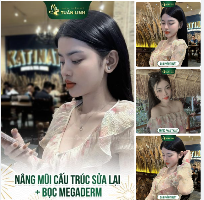 SỬA LẠI MŨI NÂNG HỎNG - TỰ TIN ĐÓN TẾT XINH!!