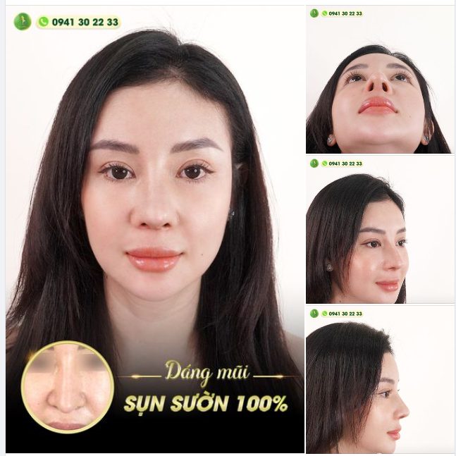 MŨI ĐẸP MỌI GÓC ĐỘ VỚI NÂNG MŨI CẤU TRÚC SỤN SƯỜN FASCIA