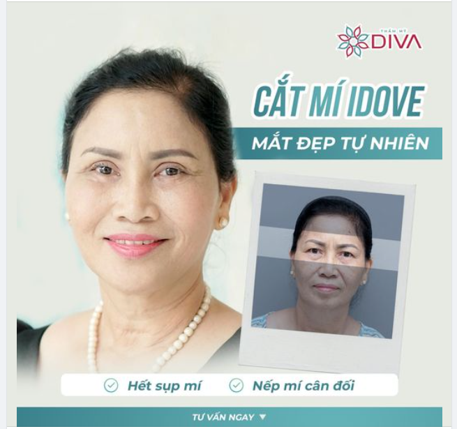 TẠM BIỆT MÍ SỤP, MẮT MỘT MÍ SAU CẮT MÍ MẮT