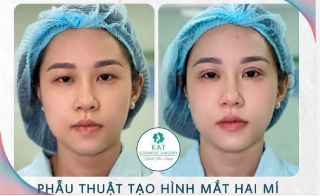 “Khắc họa vẻ đẹp bạn rõ nét hơn với đôi mắt hai mí ”