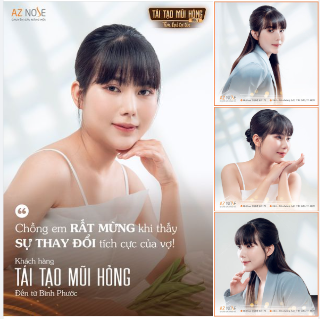 Tìm lại tự tin sau 5tháng tái tạo dáng mũi bởi BS CKI. Đinh Xuân Sơn Tùng