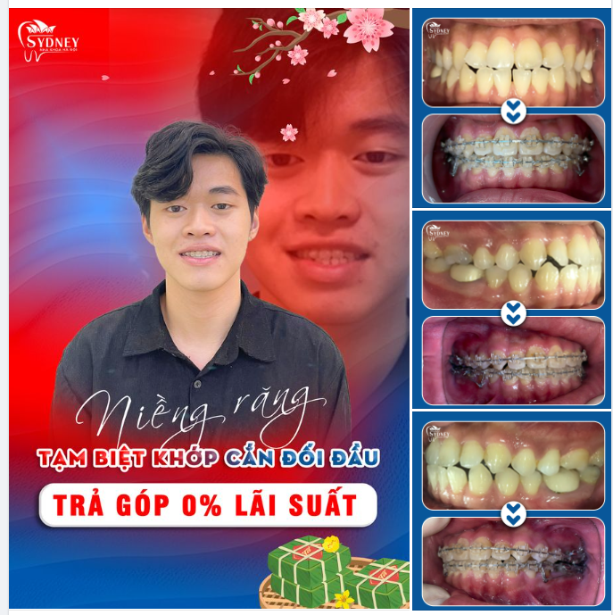 NIỀNG RĂNG KHẮC PHỤC KHỚP CẮN ĐỐI ĐẦU