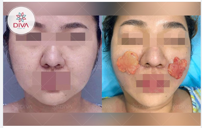 TÁCH TÚI MỠ MÁ TRONG THỰC HIỆN NHƯ THẾ NÀO?