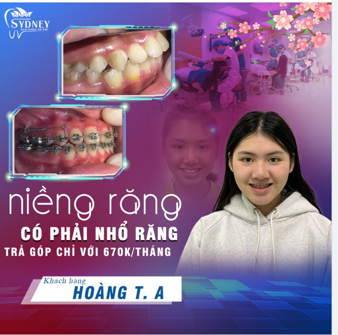 NIỀNG RĂNG HÔ CÓ CẦN NHỔ RĂNG KHÔNG?