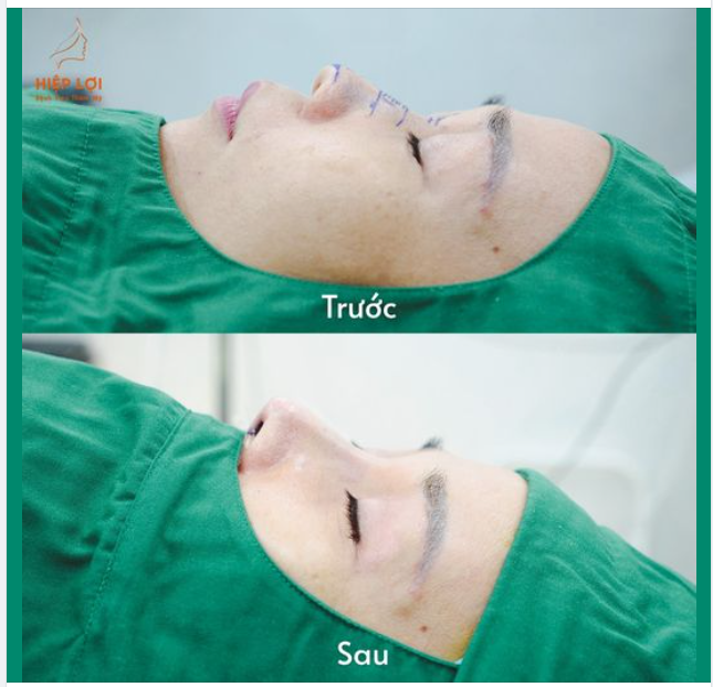 Chỉ 60 phút trong phòng mổ, chị khách đã có ngay chiếc mũi cao ưng ý