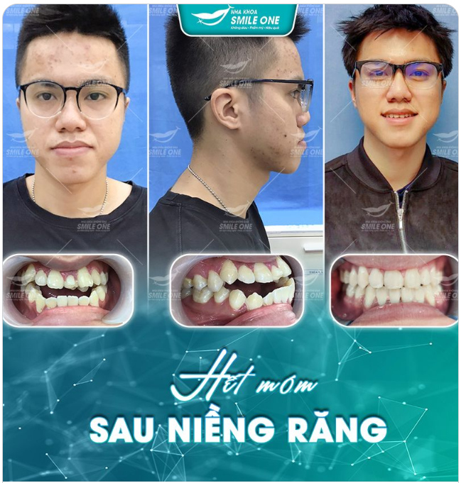 Rất khó để tin đây là ảnh trước và sau khi niềng răng của một người phải không?