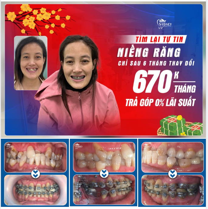 XÓA BỎ RĂNG XẤU, TÌM LẠI SỰ TỰ TIN, NỤ CƯỜI RẠNG RỠ SAU NIỀNG RĂNG