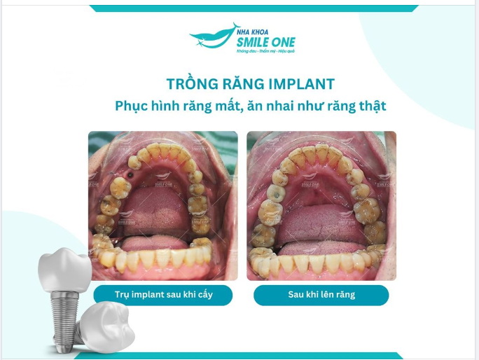 Răng Implant của chú Minh được hoàn thiện sau 2 tháng cấy trụ.