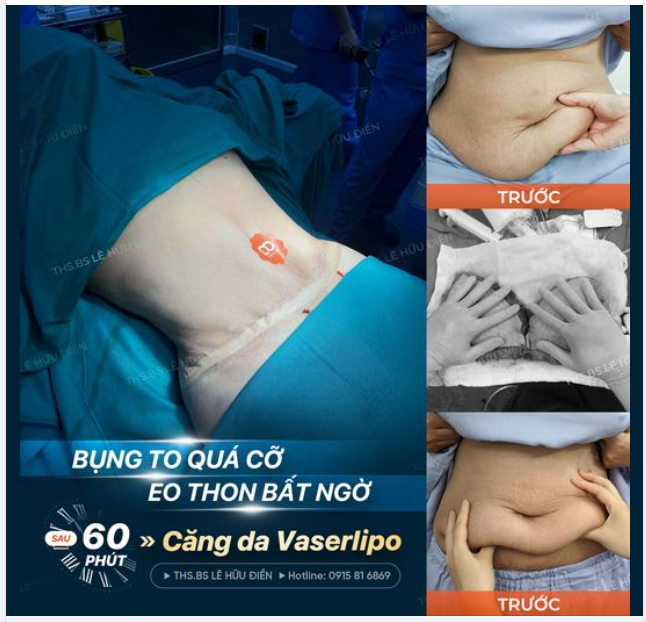 BỤNG TO QUÁ CỠ HOÁ EO THON BẤT NGỜ