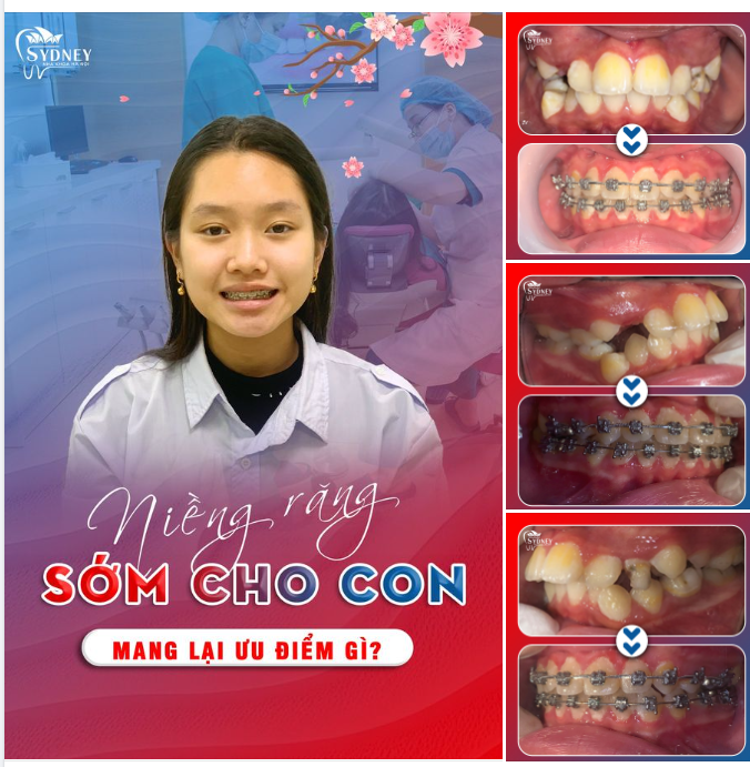 NIỀNG RĂNG CHO TRẺ TRONG ĐỘ TUỔI VÀNG  SÁNG TƯƠNG LAI – CON ĐẸP TRỌN ĐỜI