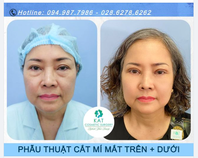 Trẻ hơn 10 tuổi chỉ sau 10 ngày phẫu thuật combo cắt mí mắt trên dưới