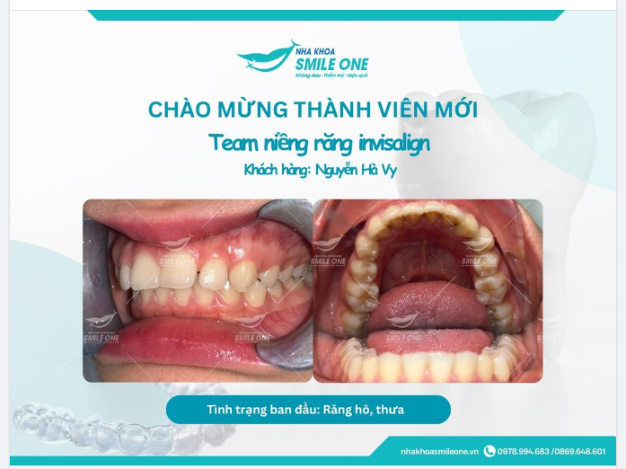 Chúc Hà Vy sớm về đích trên hành trình niềng răng của mình nhé!