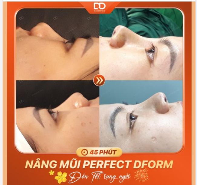 SAU 45 PHÚT NÂNG MŨI, KẾT QUẢ SẼ THẾ NÀO?