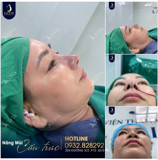 Chị N.Y đến từ Tiền Giang tự tin làm đẹp, đổi mới bản thân. Và kết quả nâng mũi cấu trúc lót megaderm cho thấy đây là sự lựa chọn đúng đắn của chị.