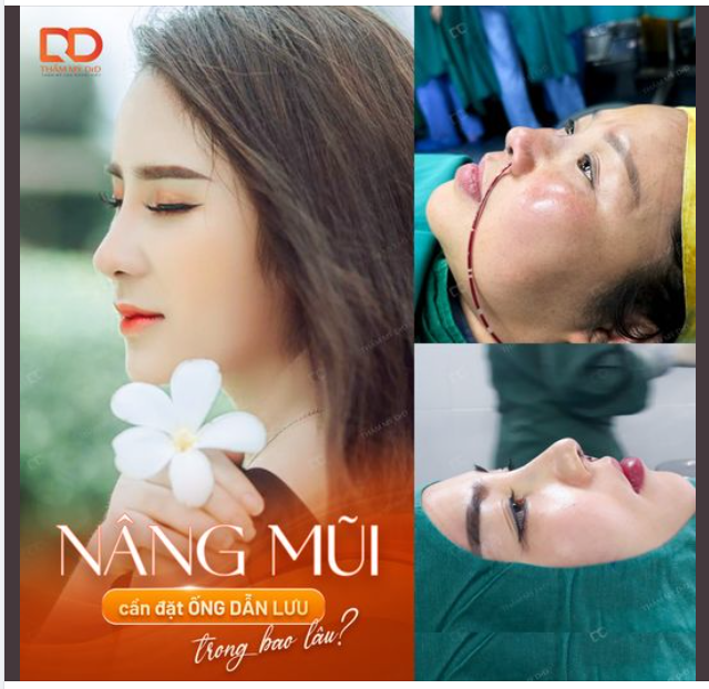 Sau khi nâng mũi phải đặt ống dẫn lưu bao nhiêu lâu ?