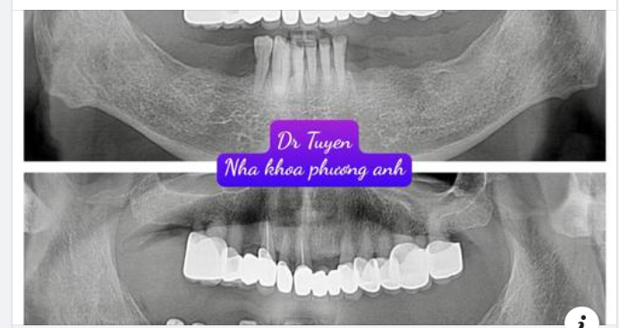 Cấy ghép implant có tốt không?