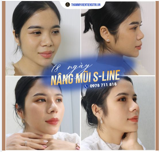 Bạn muốn có dáng mũi Sline mềm mại tự nhiên
