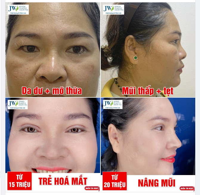 Quý bà Đài Loan U50 thay mặt ăn Tết với Combo Nâng mũi + Trẻ hoá mắt GIÁ SIÊU HỜI